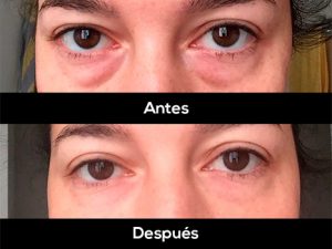 antes despues tratamiento ojeras acido hialuronico