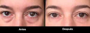 eliminar ojeras acido hialuronico