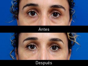 eliminar ojeras acido hialuronico valencia