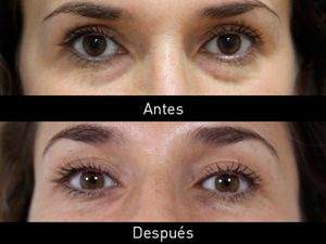 eliminar ojeras en valencia