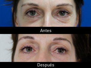 tratamiento eliminar ojeras
