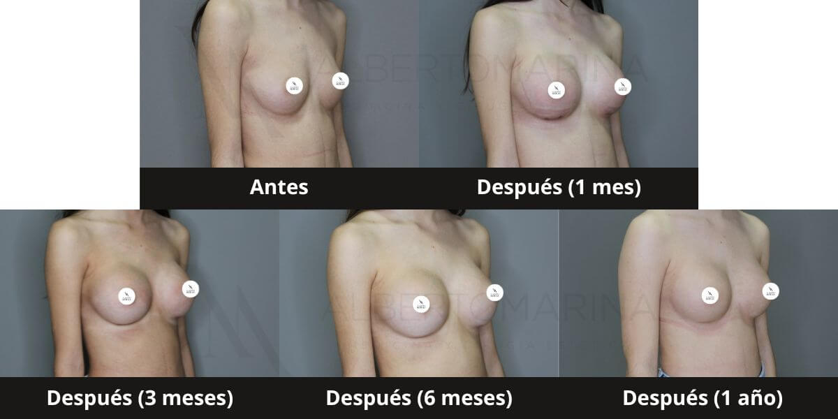 antes despues aumento pecho fotos