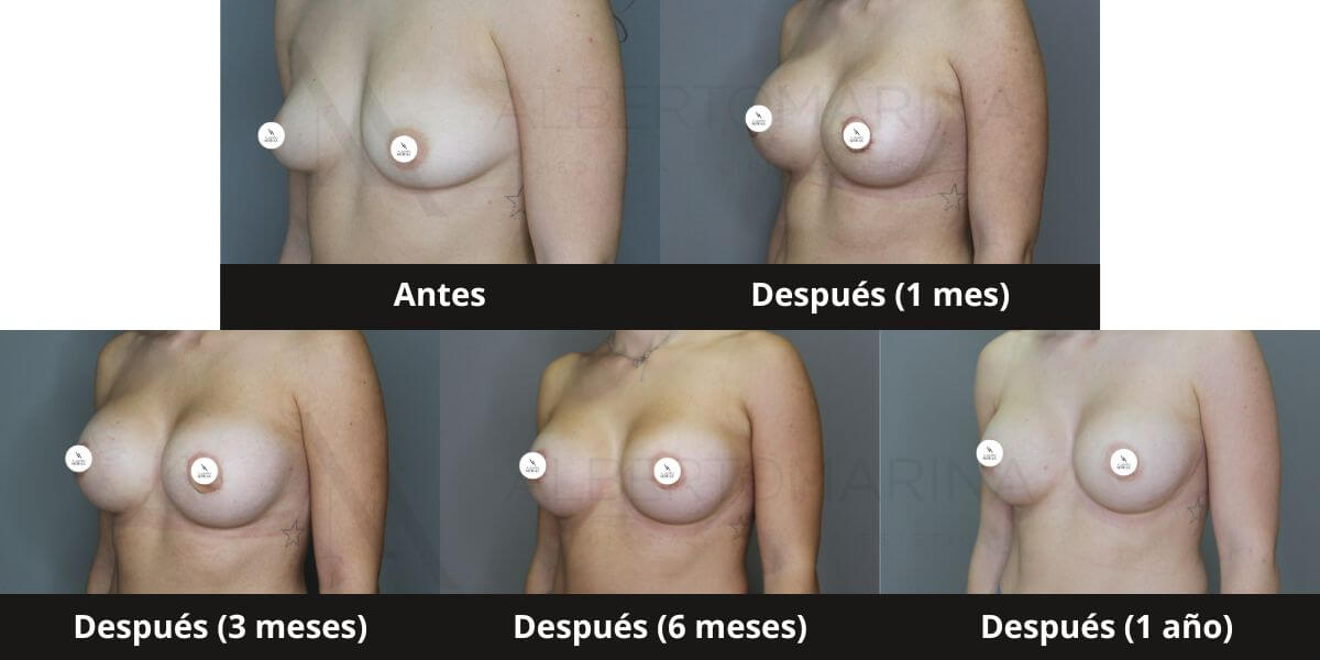 antes despues mastopexia fotos