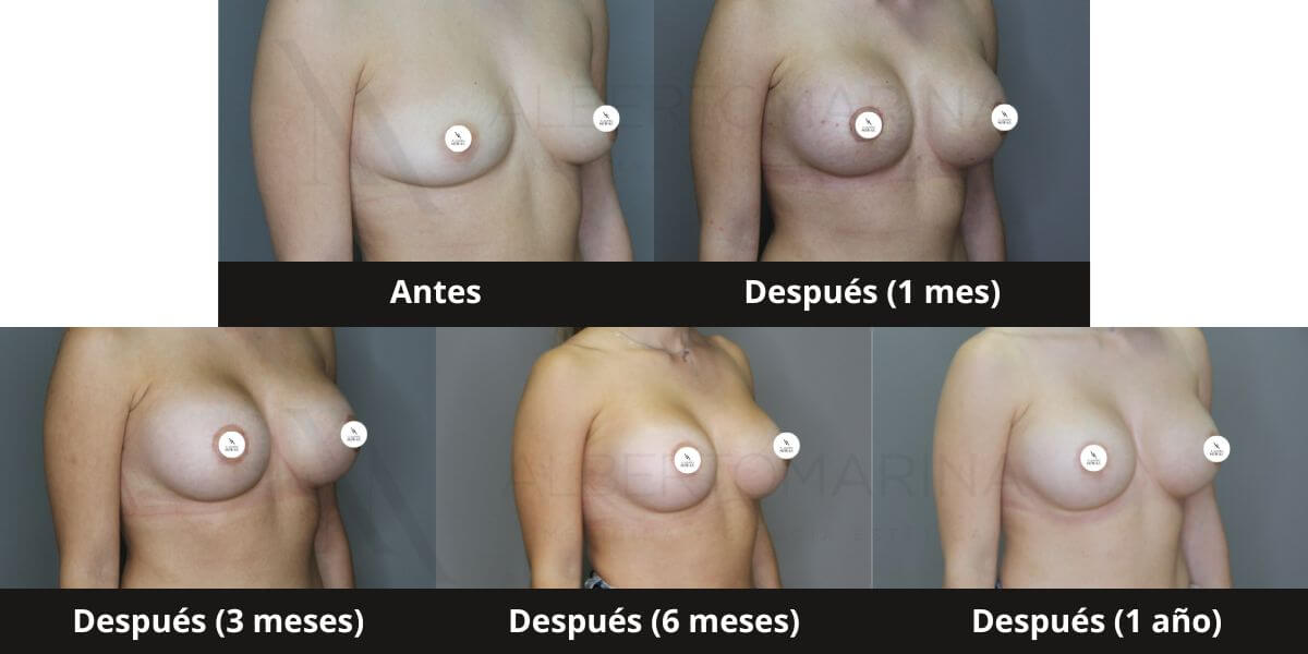 evolucion mastopexia fotos