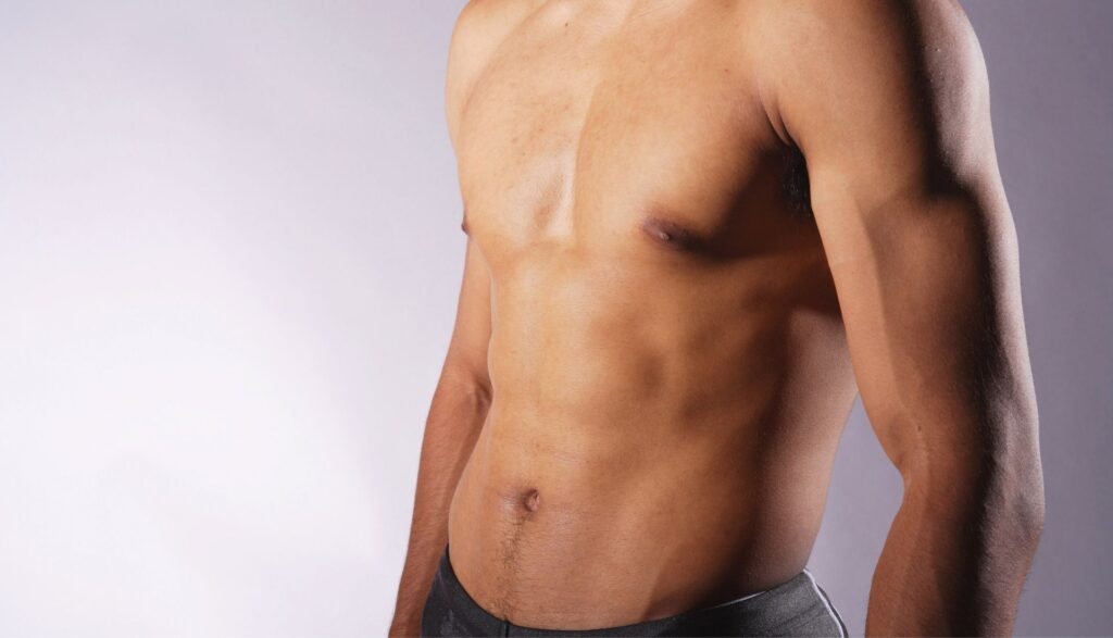 La abdominoplastia en hombres